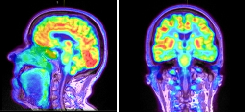 These colorful images from the PET/MR scanner within the UNC Biomedical Imaging Research Center (BRIC) show metabolism — chemical reactions that maintain live cells — in the brain. Lower rates of metabolism in the brain may be a sign of Alzheimer’s disease. (Photo courtesy of Kelly Giovanello)